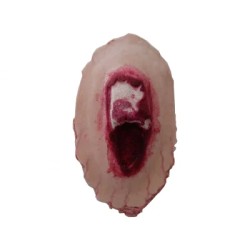 Plaie Filet Fracture...