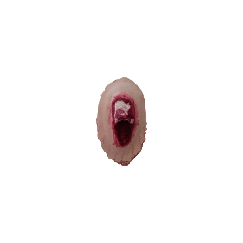 Plaie Filet Fracture ouverte Tibia