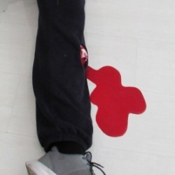 Plaie Filet Fracture ouverte Tibia