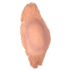 Plaie Filet Fracture