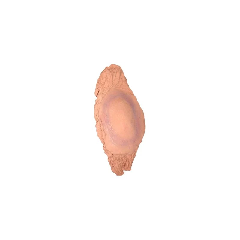 Plaie Filet Fracture