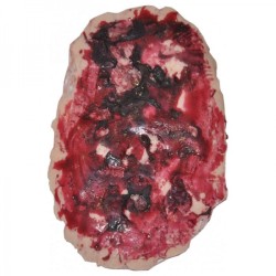 Plaie Filet Brûlure...