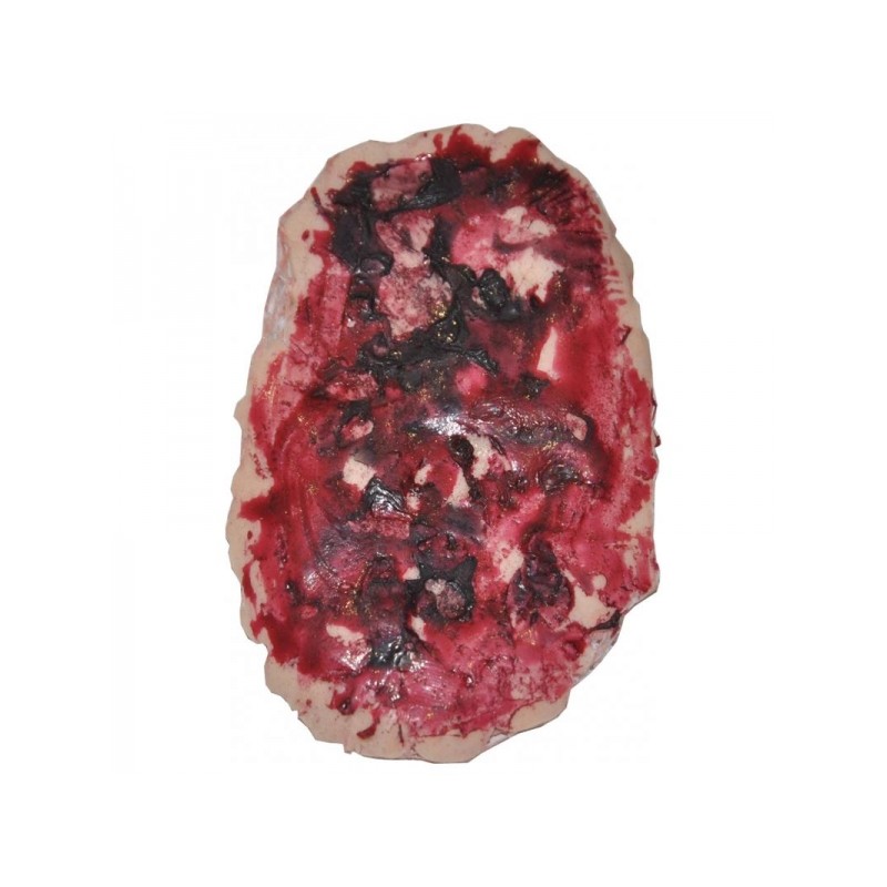 Plaie Filet Brûlure thermique avant bras